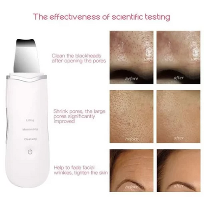 Makkafinds® Ultrasonic Facial Skin Scrubber